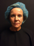 Ultherapy Case 5 Before